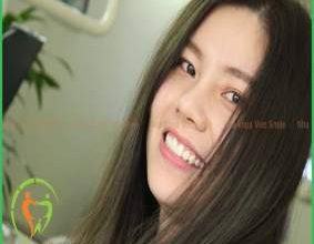 Điều trị cười hở lợi với phương pháp cắt lợi và dán sứ veneer