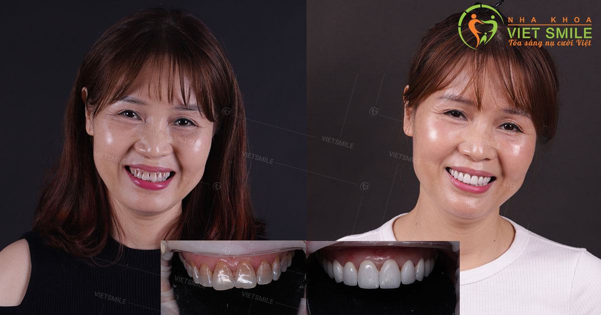 Hình ảnh trước và sau khi dán sứ veneer