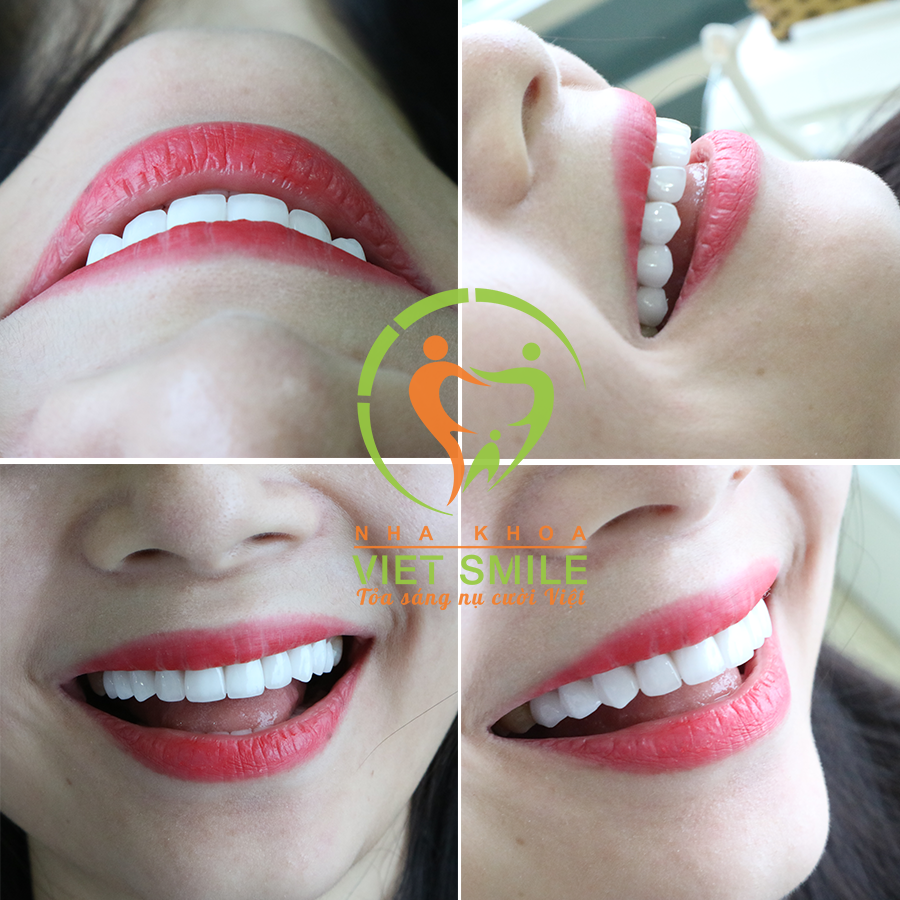 Dán sứ veneer có tốt không: dán sứ veneer 20 răng khách hàng thanh tâm 4 Cận răng dán sứ veneer