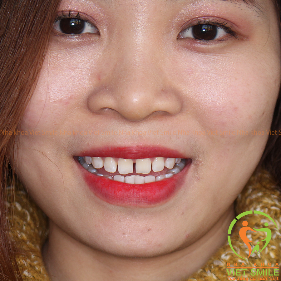 Răng trước khi dán sứ veneer