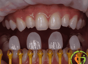 Bọc răng sứ thẩm mỹ - Ác mộng của nhiều bạn trẻ