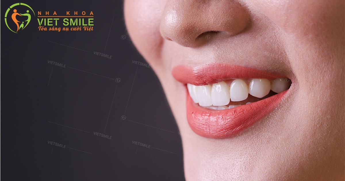 dán sứ veneer giá bao nhiêu? bảng giá cập nhật mới nhất 2021 1 Dán sứ veneer giá bao nhiêu? Bảng giá cập nhật mới nhất 2002