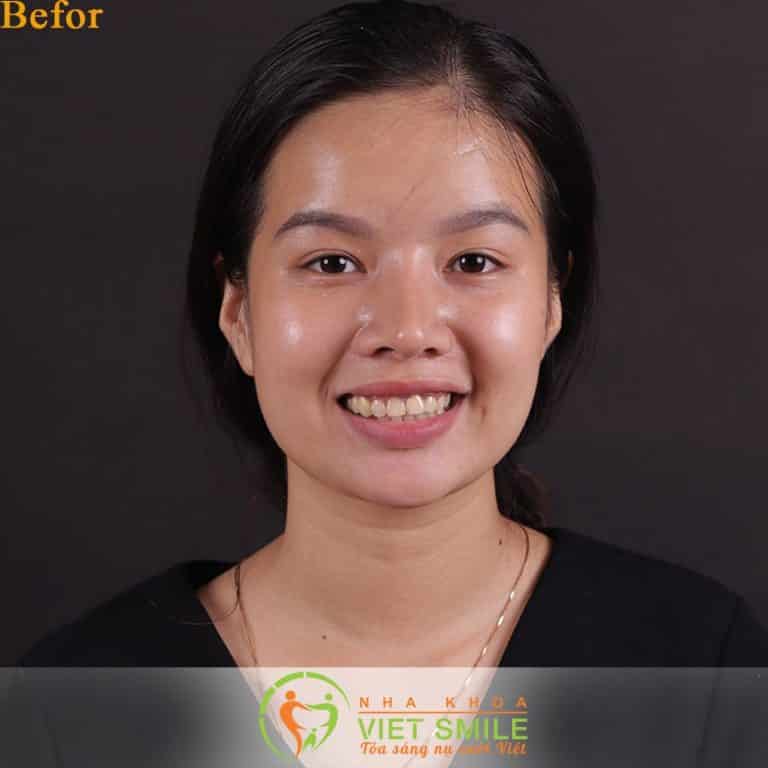 Review dán sứ veneer kết hợp bọc răng sứ của khách hàng thực tế 2 Dan su veneer nha khoa viet smile