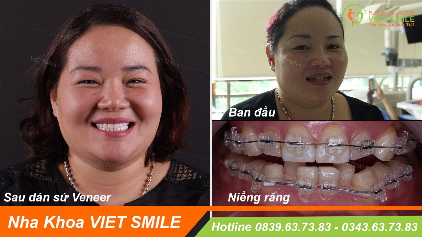 Khách hàng lựa chọn niềng răng trước khi dán sứ veneer vì nụ cười chắc khỏe
