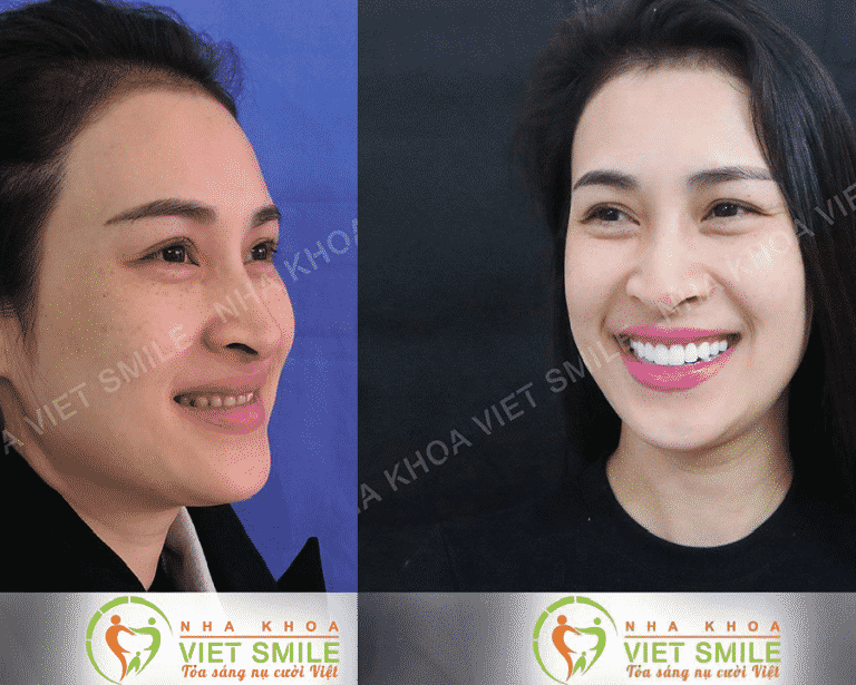 nha khoa viet smile boc rang su