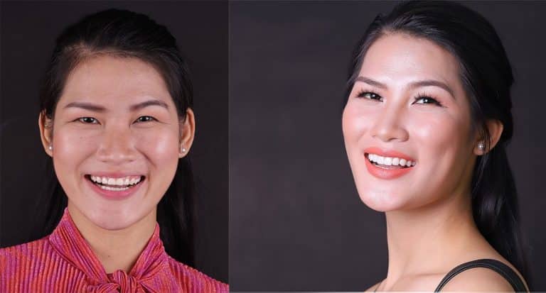 dan su veneer viet smile
