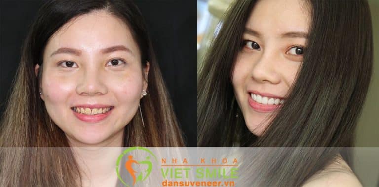 cat loi ket hop dan su veneer Viet Smile