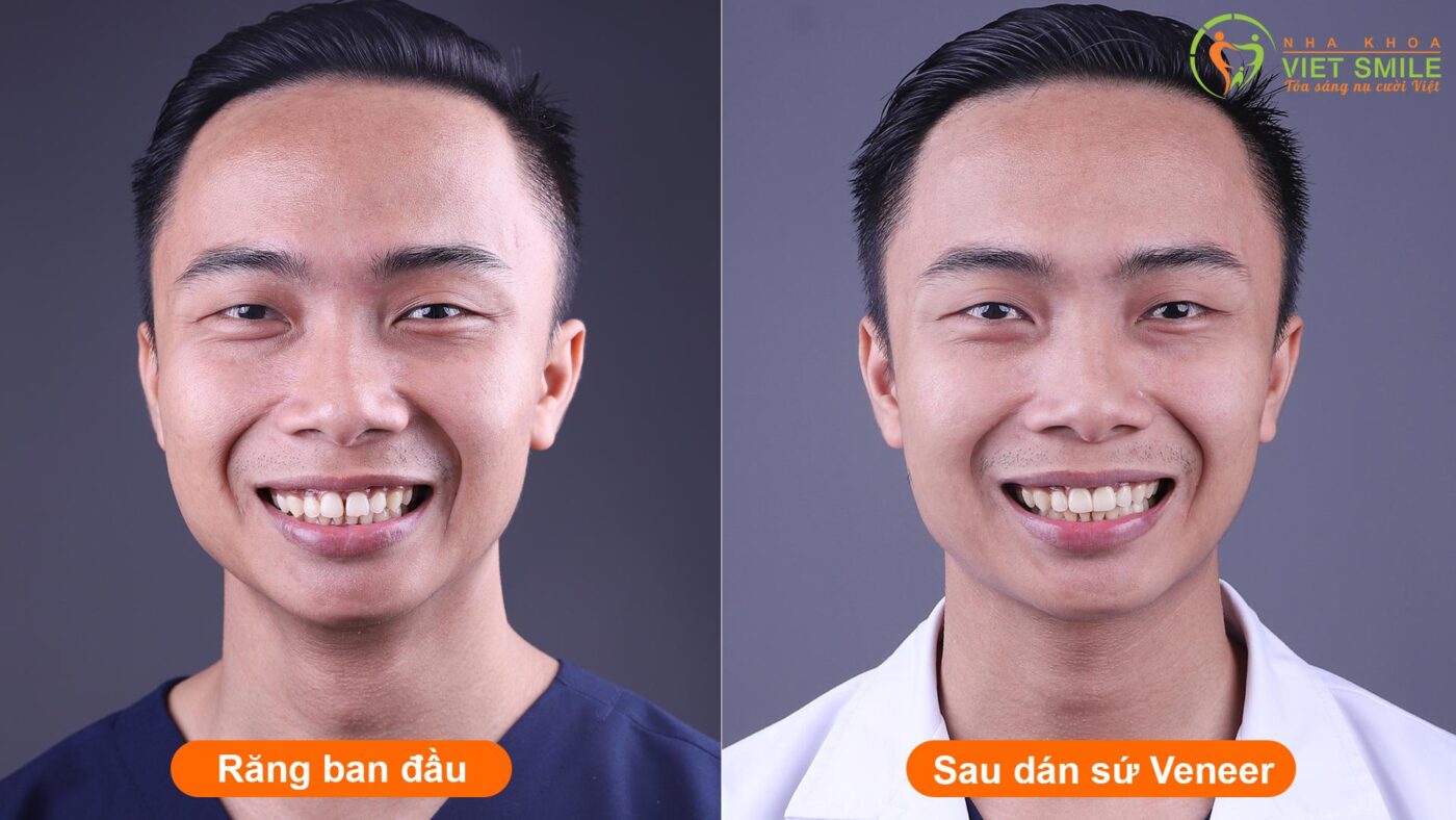 Trước và sau dán răng sứ không mài răng của bác sĩ trần xuân đăng tại nha khoa việt smile