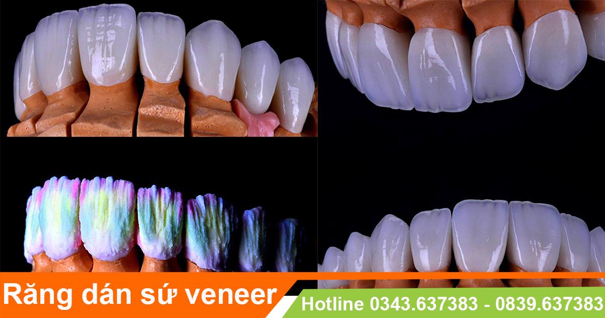 chăm sóc răng sau dán sứ veneer đúng cách 1 Chăm sóc răng dán sứ veneer