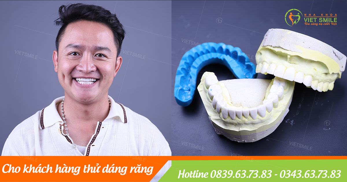 Lam mock-up và wax-up dáng răng trực tiếp trên miệng khách hàng