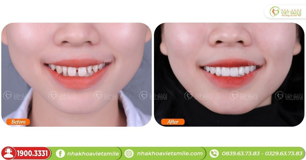 Răng dán sứ veneer giá bao nhiêu? - bảng giá dán sứ mới nhất 15 Quyền lợi cho khách hàng khi dán sứ thẩm mỹ tại việt smile