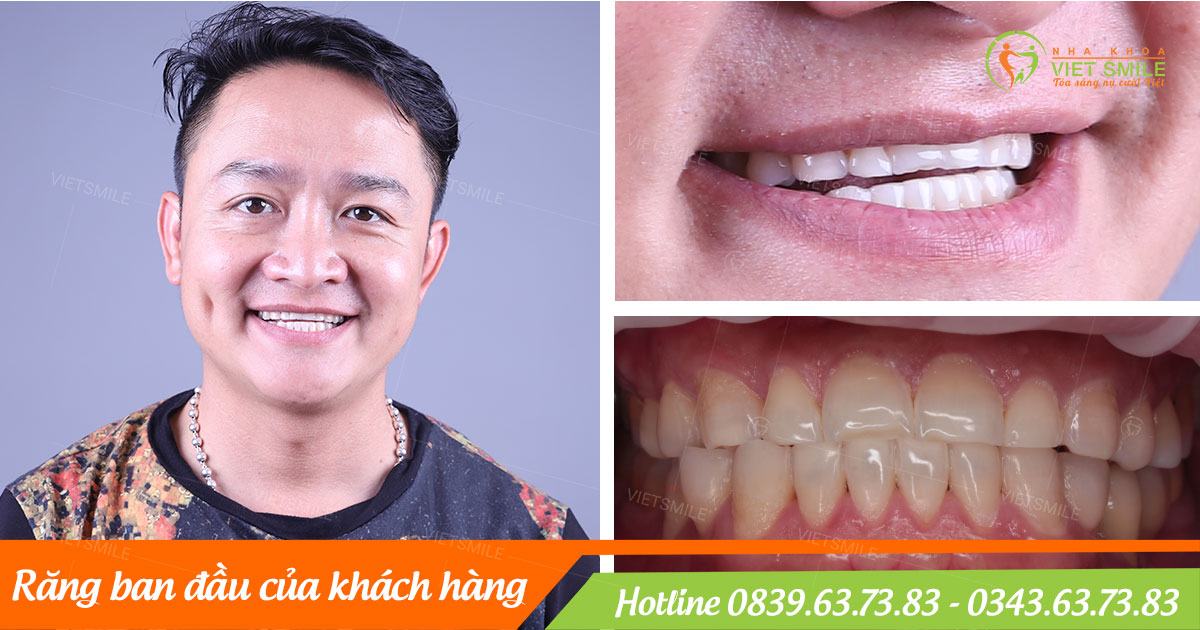 Dan rang su và quy trình chuẩn tại nha khoa việt smile 5 Răn ban đầu trước khi dán răng sứ
