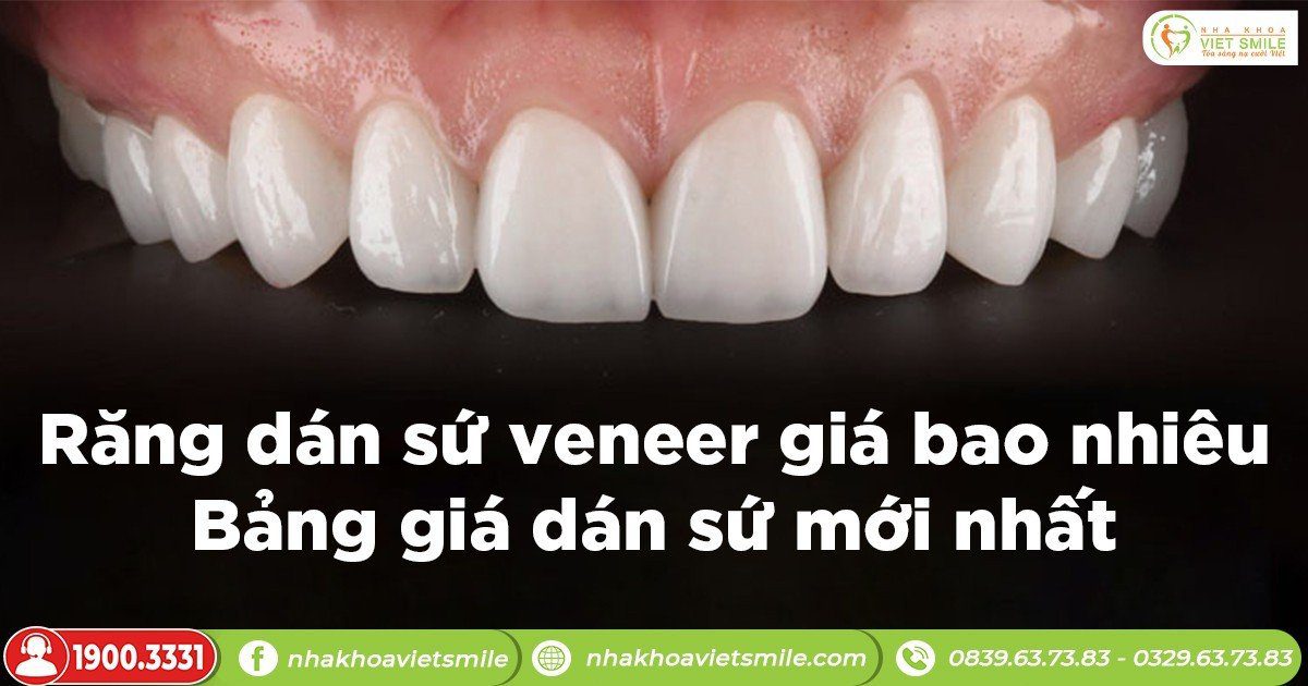 Răng dán sứ veneer giá bao nhiêu? - bảng giá dán sứ mới nhất 9 Răng dán sứ veneer giá bao nhiêu? - bảng giá dán sứ mới nhất