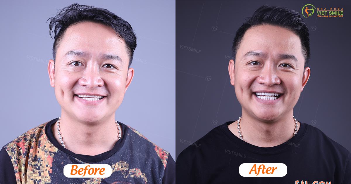 Dán sứ veneer có tốt không? 1 Khách hàng trần đăng khoa dán sứ veneer