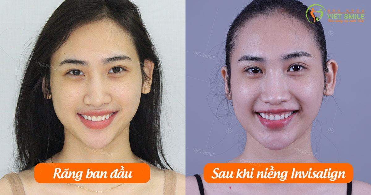 Trước và sau khi sử dụng mặt dán sứ veneer