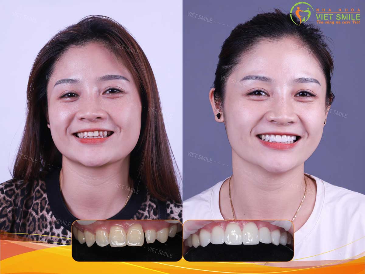 Khách hàng trước và sau bọc răng sứ