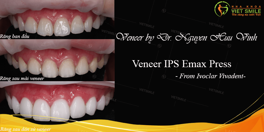 Dán sứ veneer emax có bền không? Có nên dán răng sứ không? 2 Dán sứ veneer emax có tốt không?