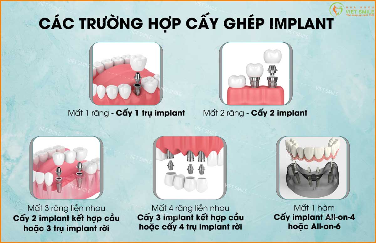 địa chỉ cấy ghép implant tốt ở hà nội, cấy implant trả góp 1 Địa chỉ cấy ghép implant tốt ở hà nội, cấy implant trả góp