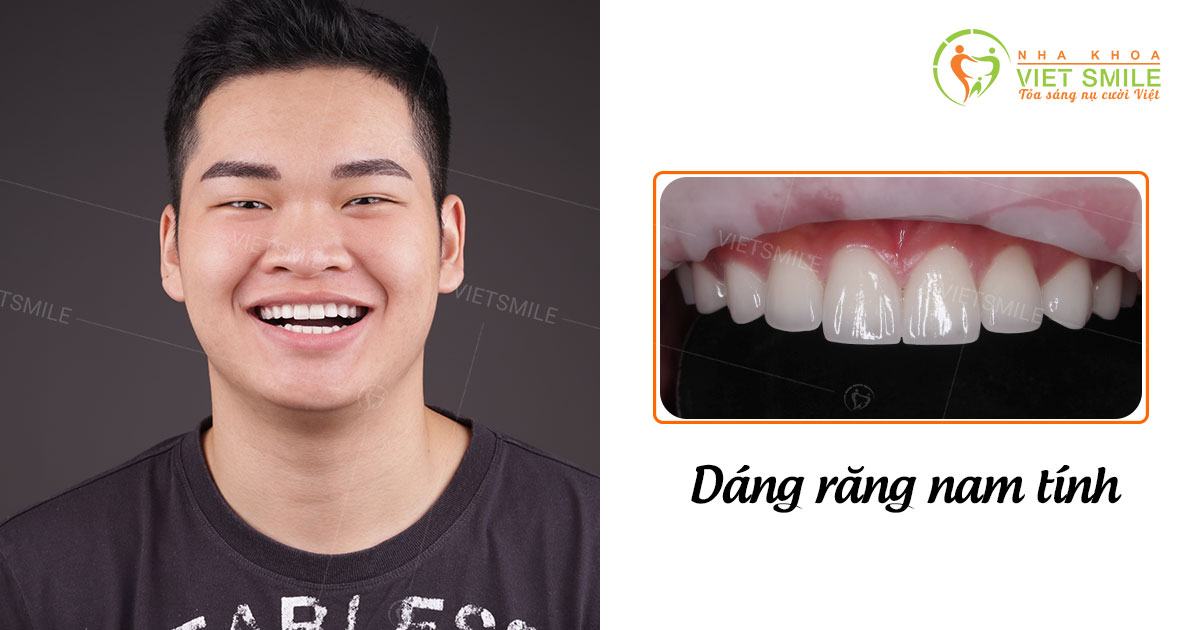 8 điều nên biết về bọc răng sứ - dán răng sứ veneer 4 Bọc răng toàn sứ