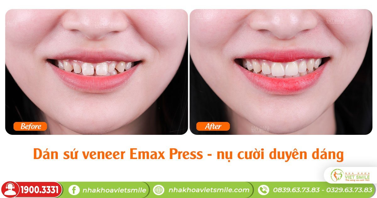 Răng dán sứ veneer giá bao nhiêu? - bảng giá dán sứ mới nhất 16 Chi phí dán sứ veneer cho nụ cười duyên dáng