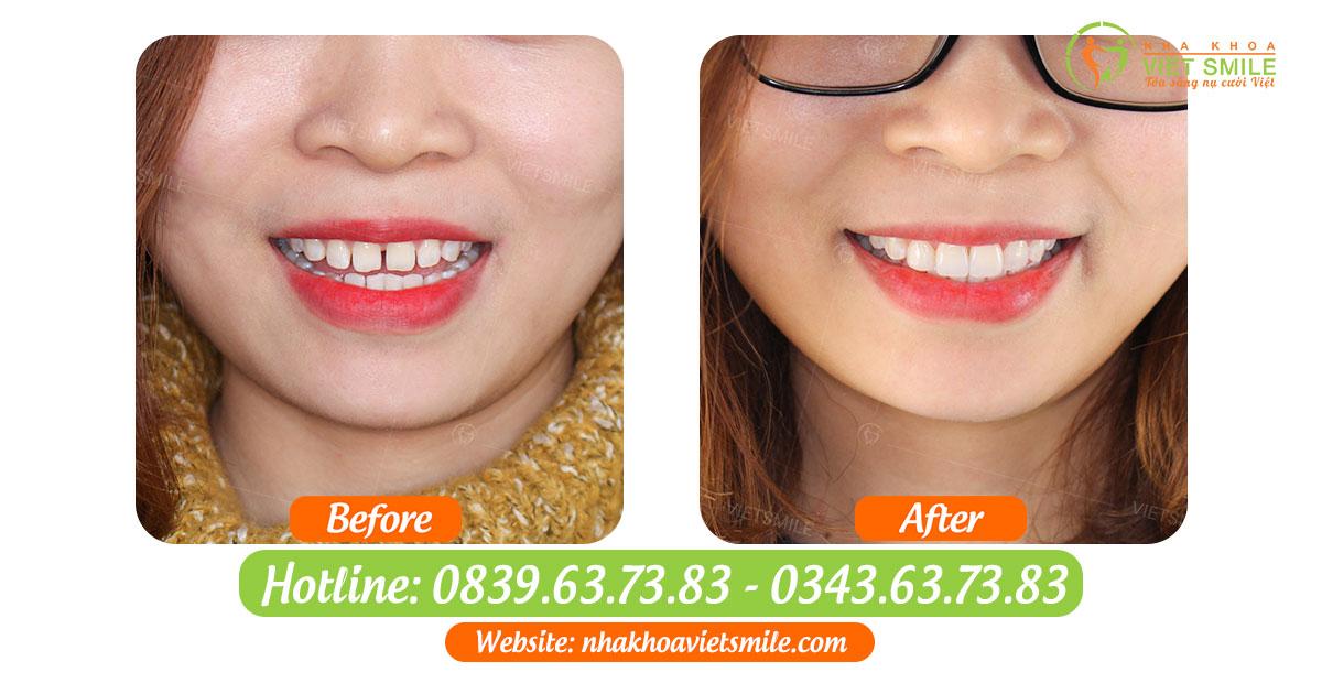 Bao nhiêu tuổi dán sứ veneer được? 7 Mieng dan rang thua veneer