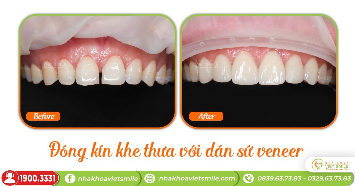 Dán sứ veneer 2 răng cửa thưa bao nhiêu tiền? 12 Dong-khe-thua-voi-dan-su-veneer