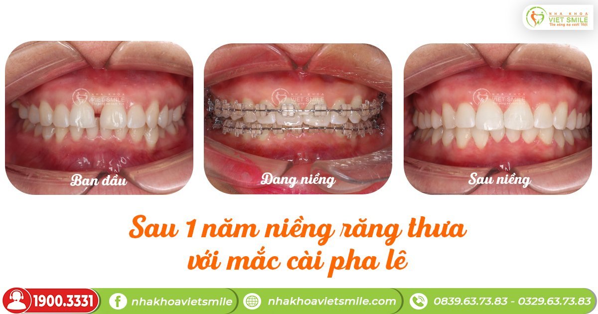 Dán sứ veneer 2 răng cửa thưa bao nhiêu tiền? 11 Nieng-rang-dong-kin-khe-thua