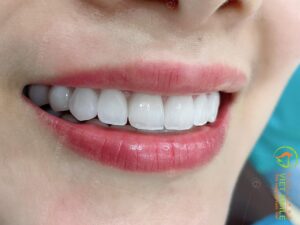chọn bọc răng sứ hay dán sứ veneer 2 Veneer