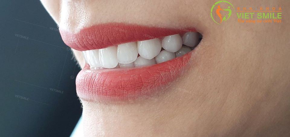 Dán răng sứ veneer loại nào tốt nhất? 6 Dansu dan rang su veneer 1