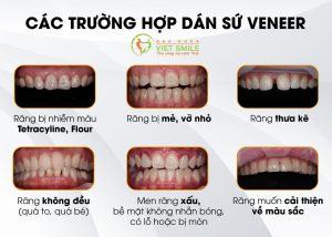răng sứ veneer có bị xỉn màu không? 2 Dán sứ răng veneer
