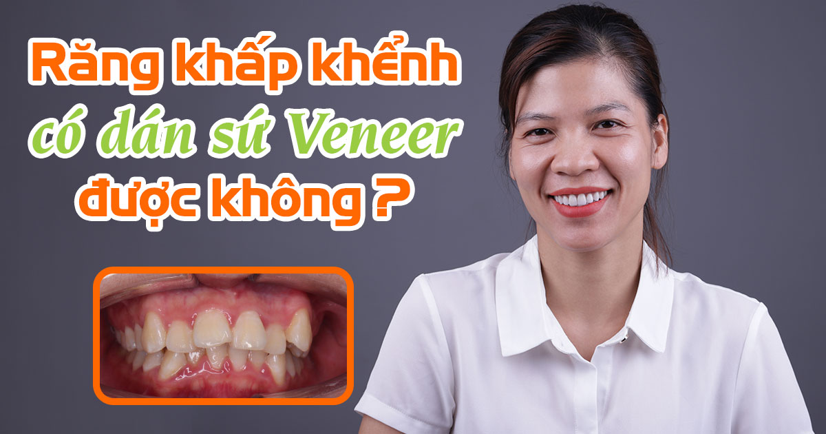 Răng khấp khểnh có dán sứ veneer được không?