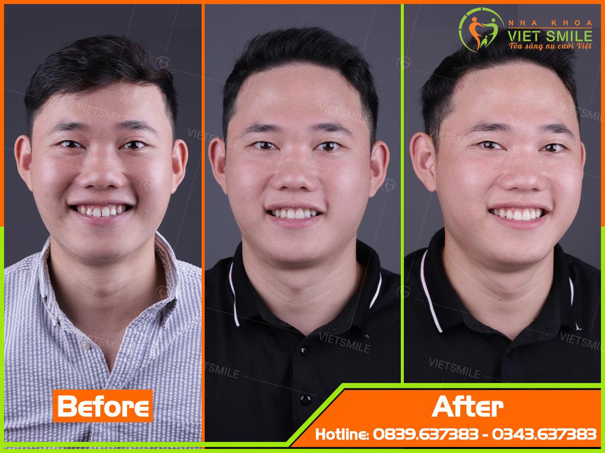 Dán sứ veneer đóng khe thưa răng cửa có bền không? 4 Nụ cười khách hàng sau khi dán sứ veneer 6 răng cửa để đóng khe thưa