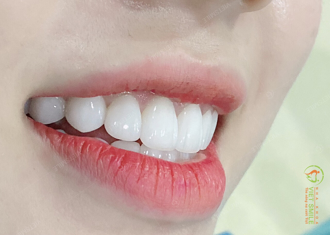 Dán sứ veneer - giải pháp thẩm mỹ răng sứ hiện đại nhất 2 Dán sứ veneer màu trắng trong tự nhiên đang là xu hướng được đa số các khách hàng lựa chọn