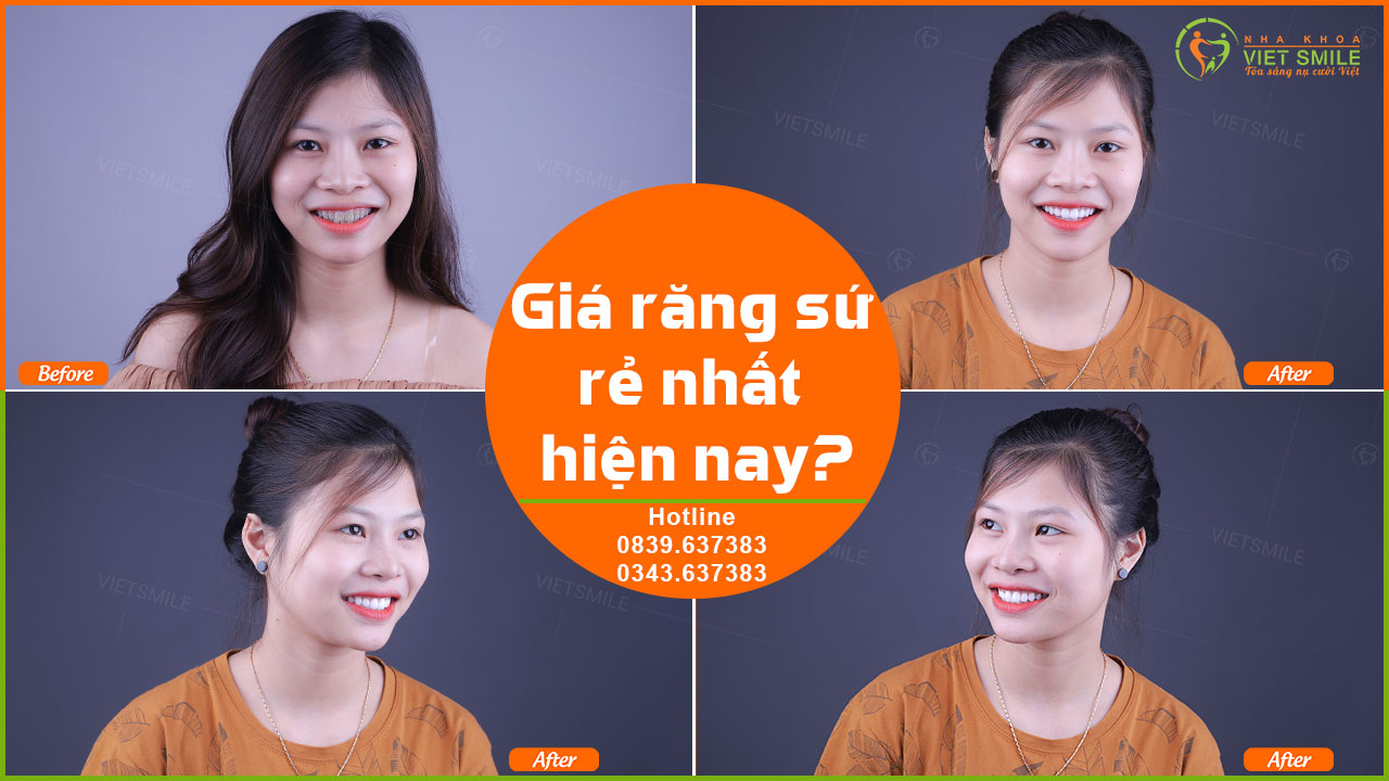 Giá răng sứ rẻ nhất hiện nay? 5 Giá răng sứ rẻ nhất hiện nay?