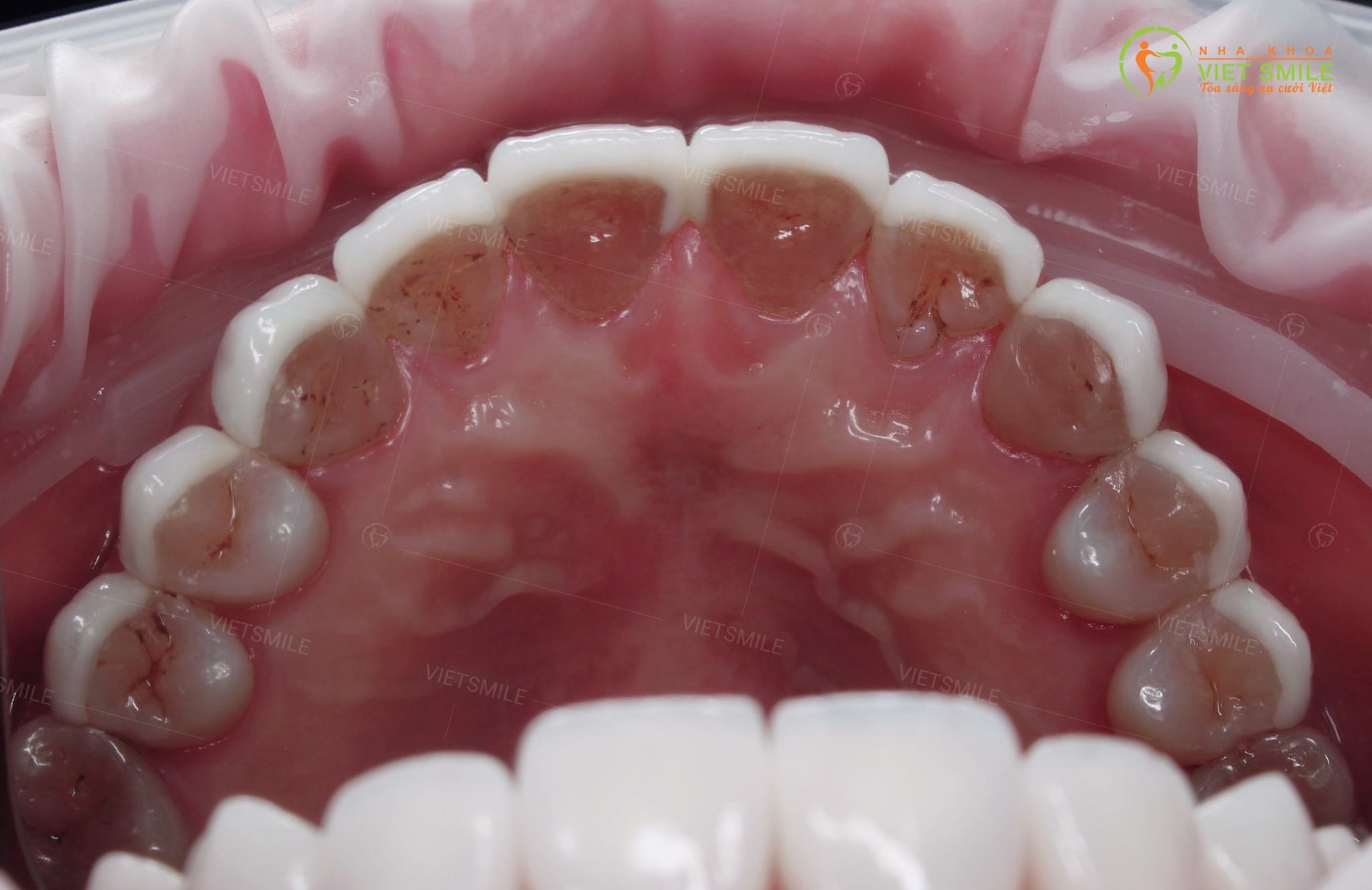 Mặt trong hàm trên răng dán sứ veneer