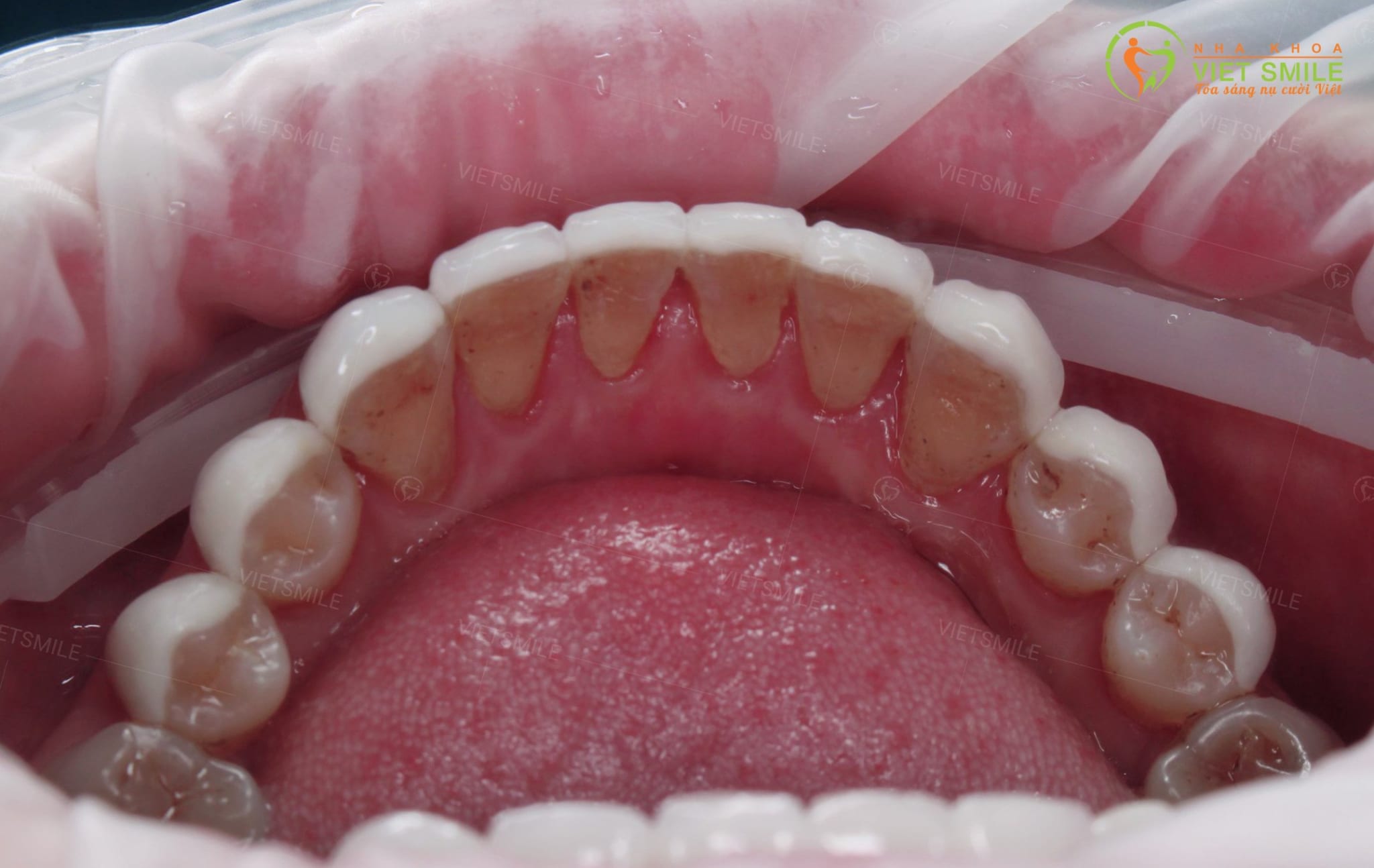 Mặt trong hàm dưới răng dán sứ veneer