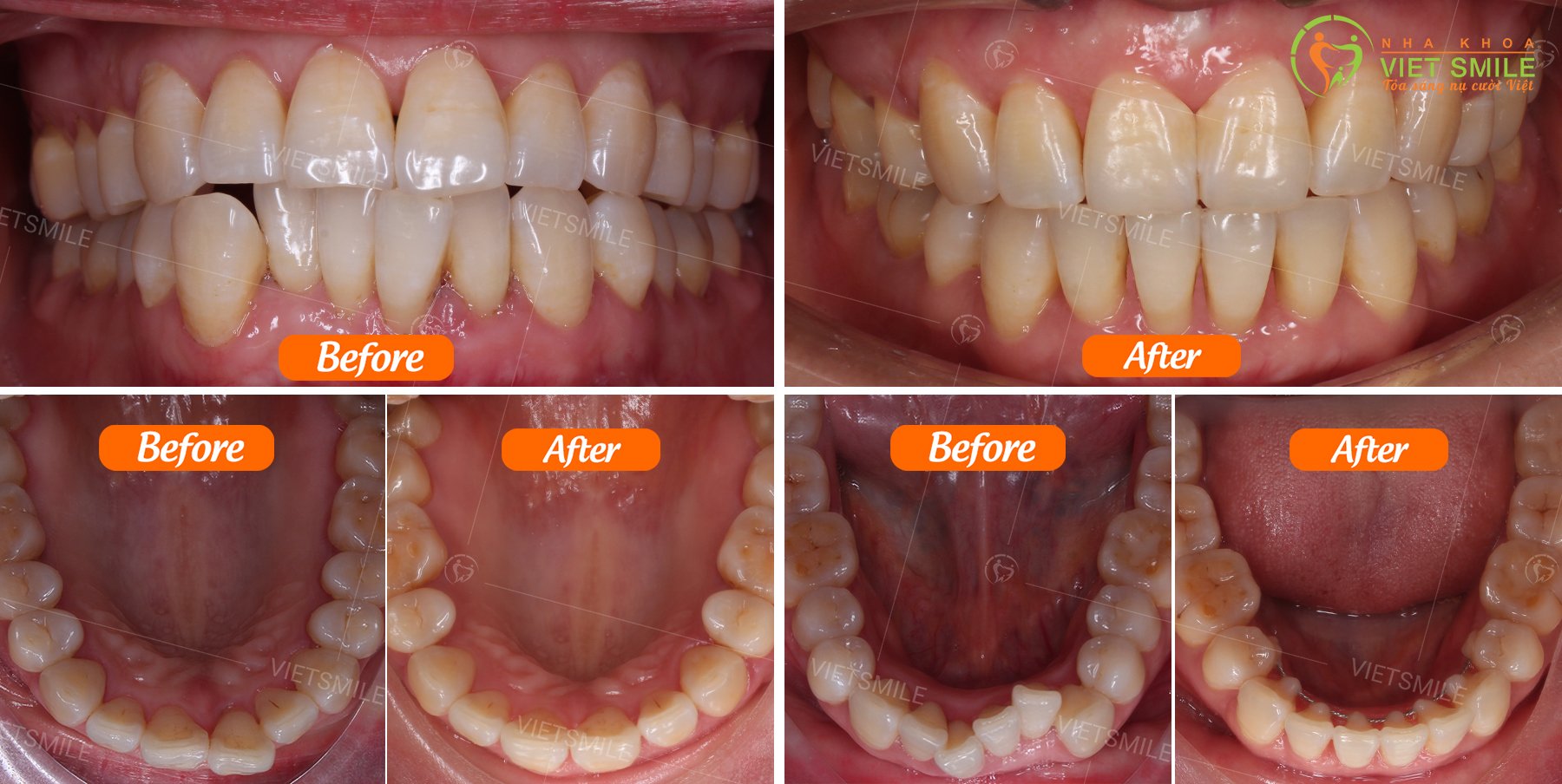 Răng không đều có dán sứ được không? 10 Sự thay đổi của cung răng sau khi niềng