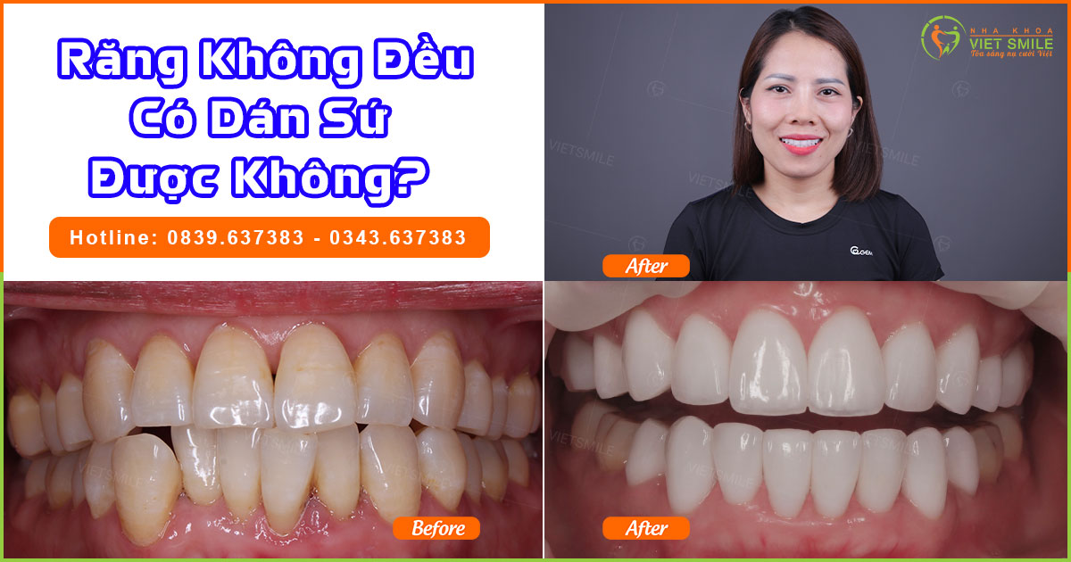 Răng không đều có dán sứ được không? 7 Răng không đều có dán sứ được không?