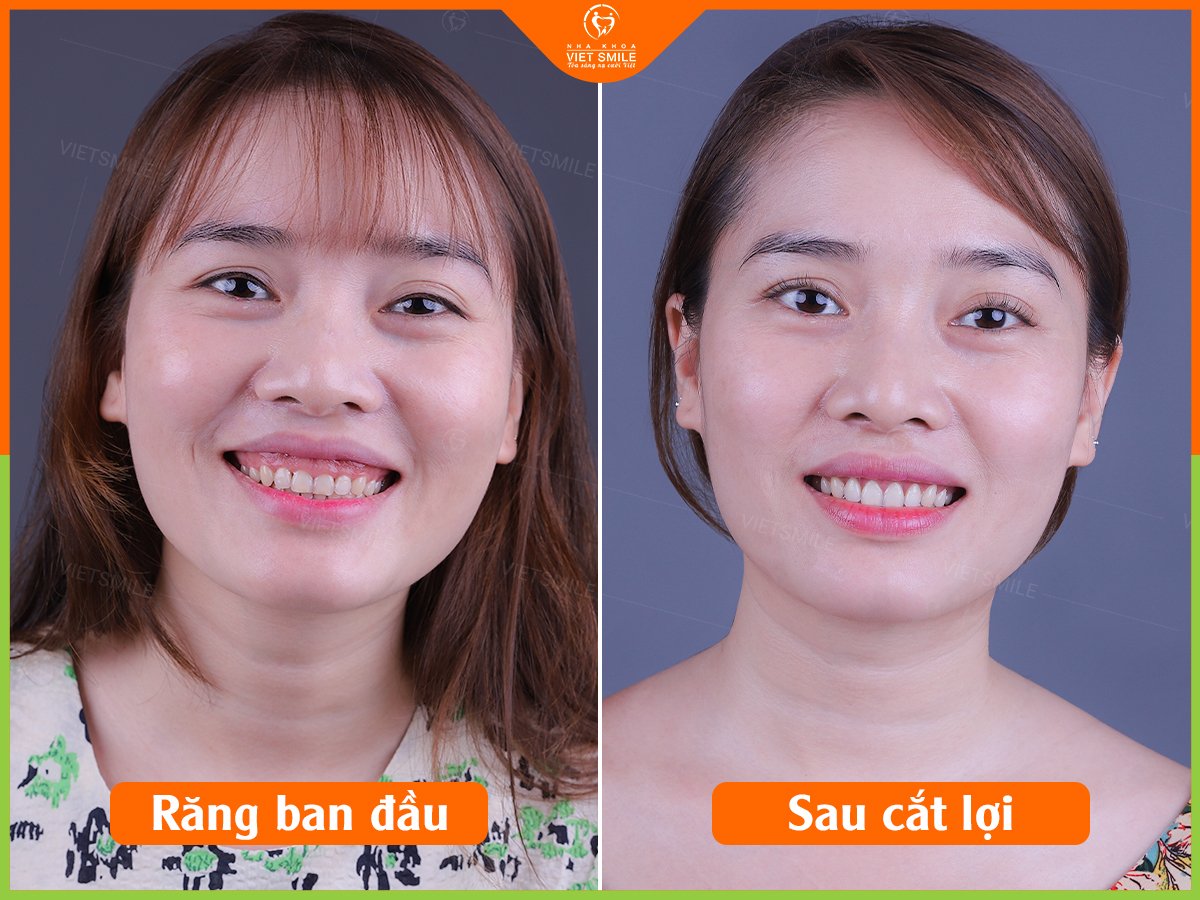 Trước và sau cắt lợi thẩm mỹ tại nha khoa việt smile