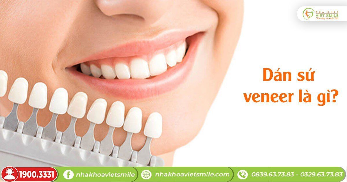 Quy trình dán sứ veneer đúng chuẩn y khoa như thế nào? 10 Dán sứ veneer là gì?