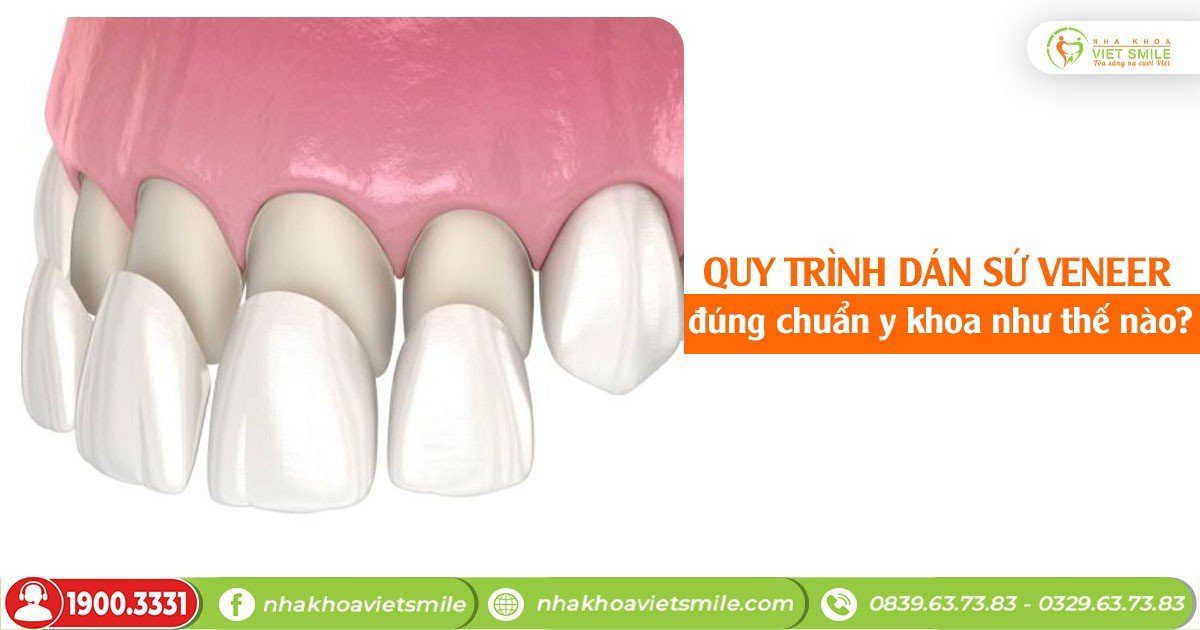 Quy trình dán sứ veneer đúng chuẩn y khoa như thế nào? 9 Quy trình dán sứ veneer đúng chuẩn y khoa như thế nào?