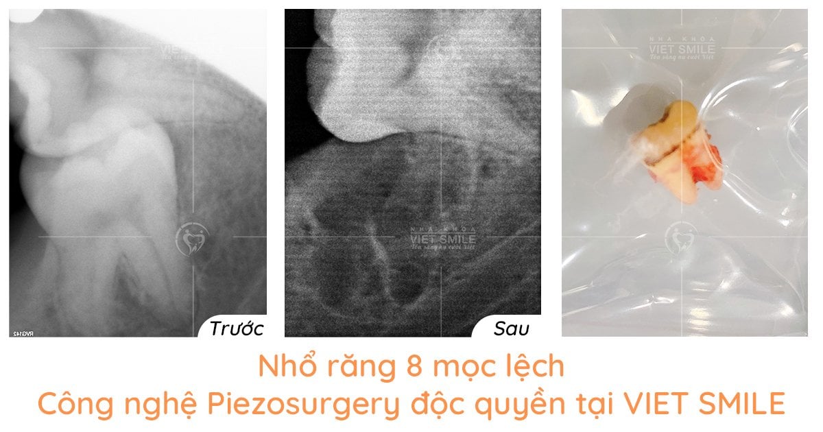Nhổ răng piezosurgery