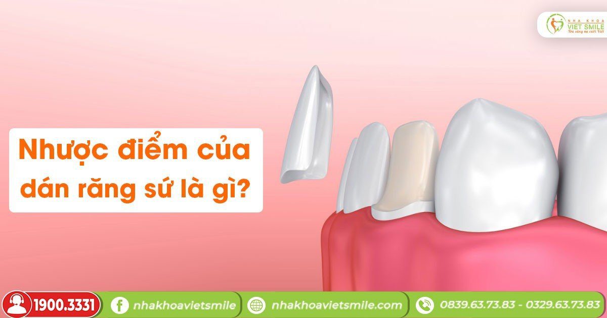Nhược điểm của dán răng sứ là gì?