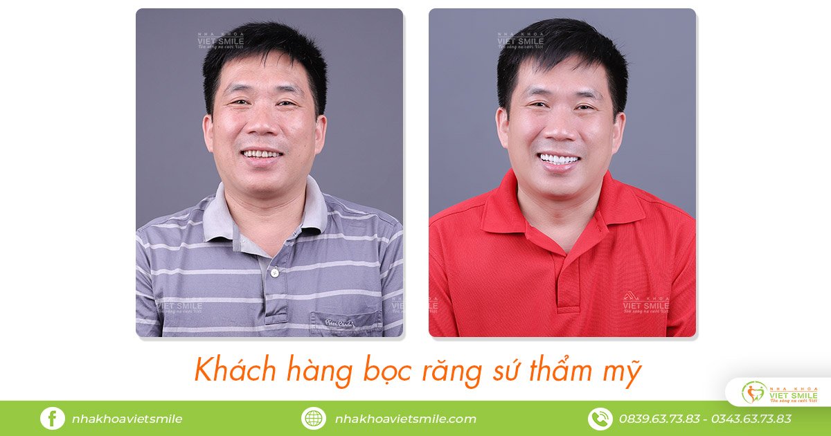 Chọn bọc răng sứ hay dán sứ veneer 3 An tâm làm răng sứ