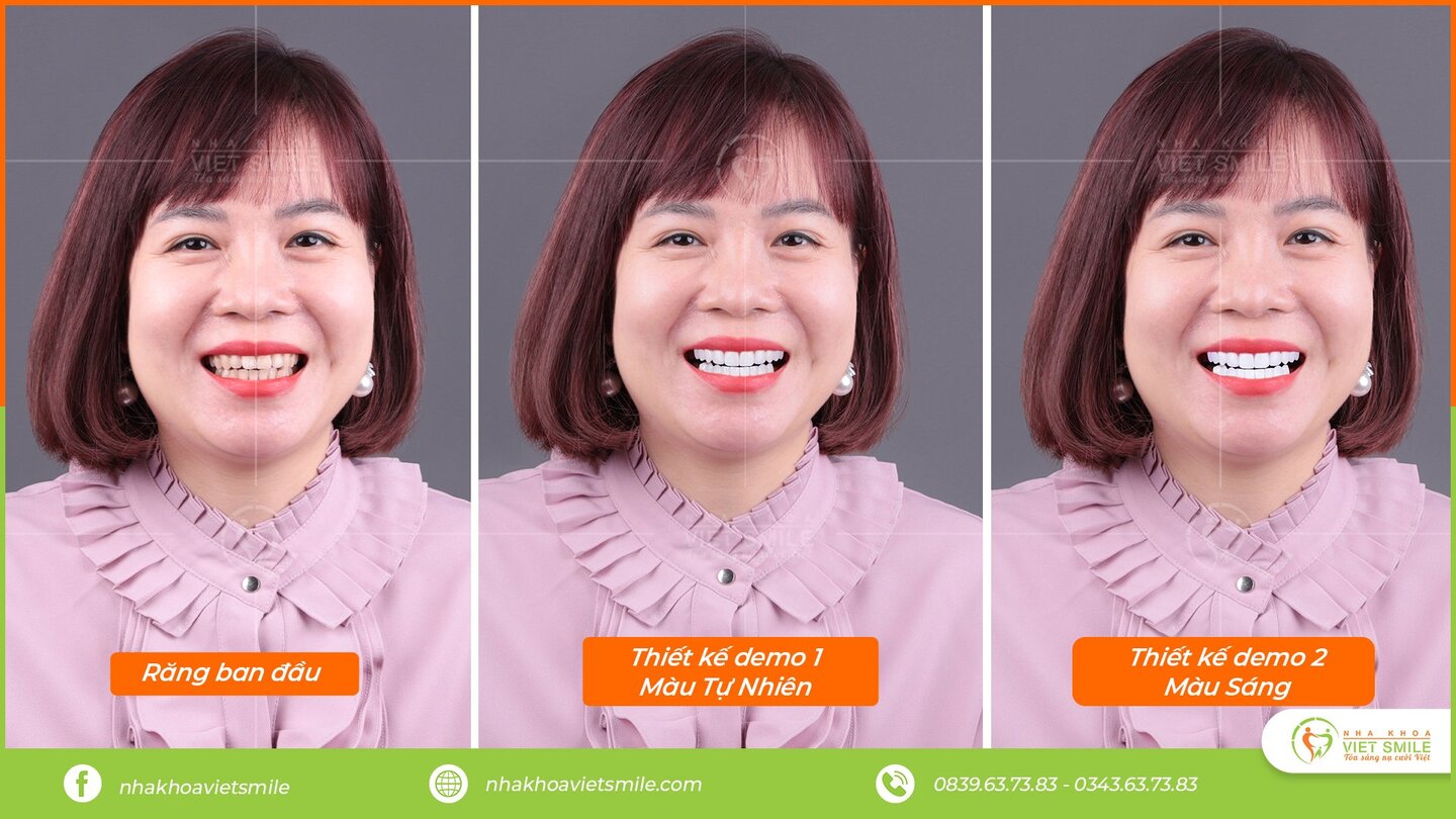 Mặt dán veneer sứ – phục hình thẩm mỹ bảo tồn răng thật 15 Digital smile design - sds