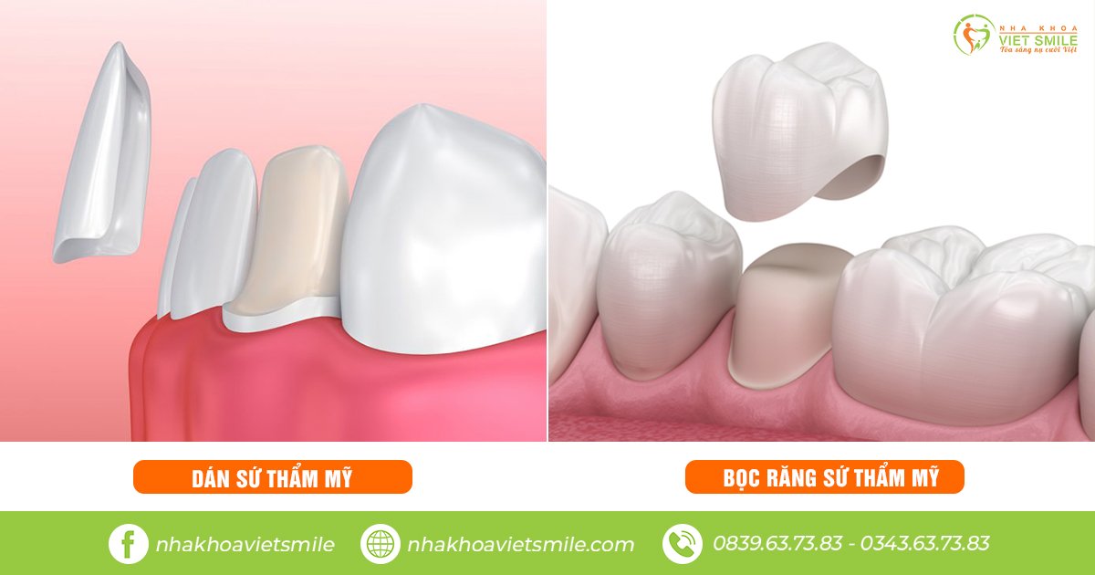 So sánh dán răng sứ thẩm mỹ và bọc răng sứ