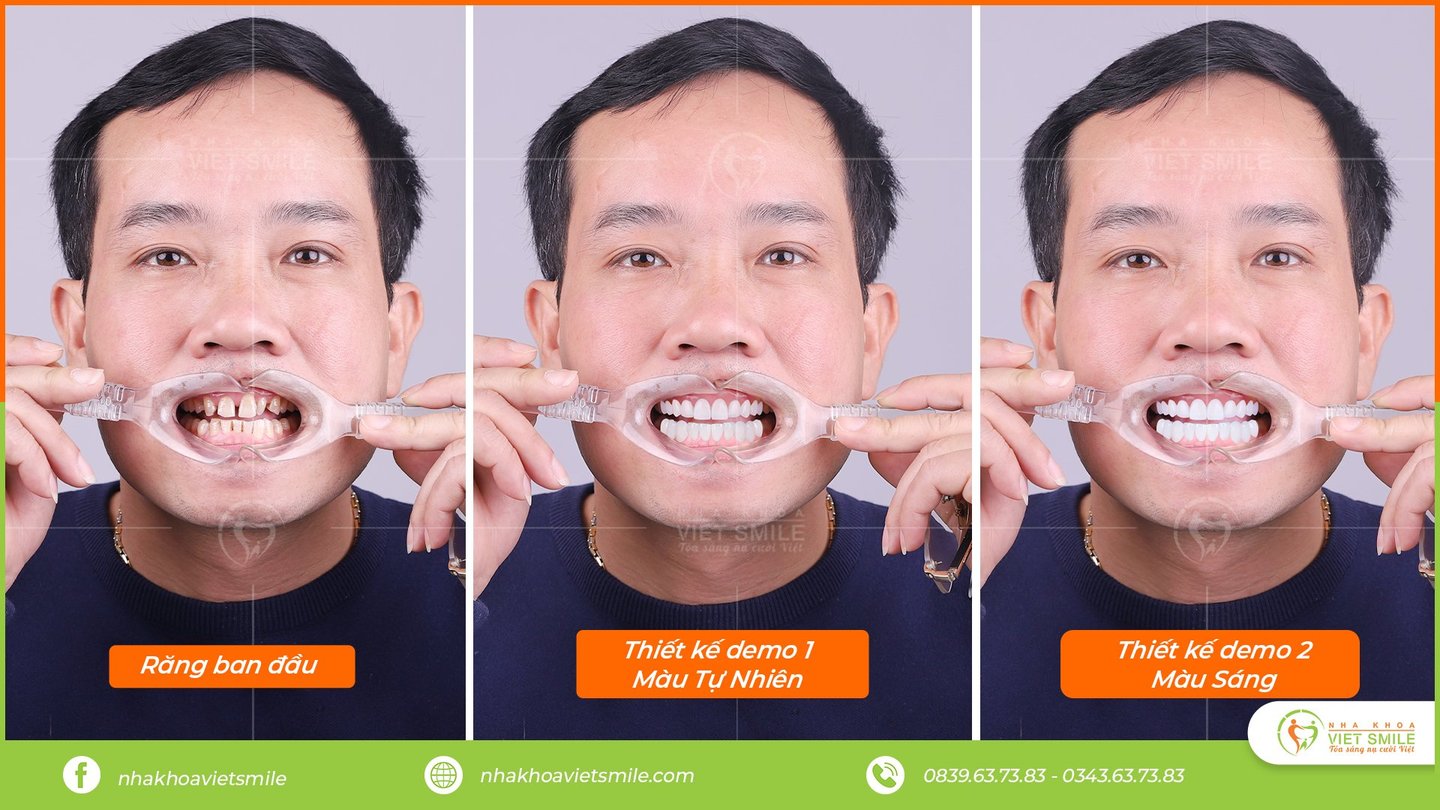 Quy trình dán mặt sứ veneer cho nụ cười 4. 0 7 Thiết kế nụ cười