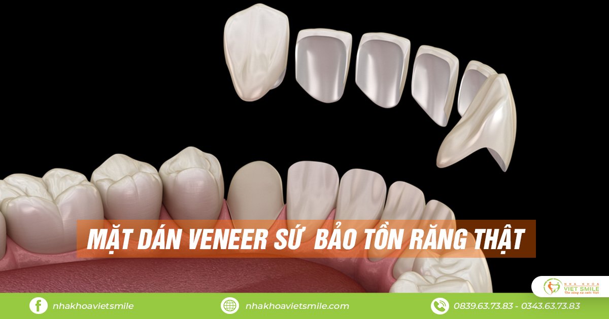 Mặt dán veneer sứ – phục hình thẩm mỹ bảo tồn răng thật 9 Mặt dán veneer sứ