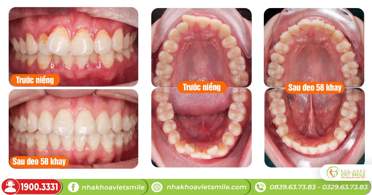 Răng thay đổi mỗi ngày nhờ niềng răng invisalign