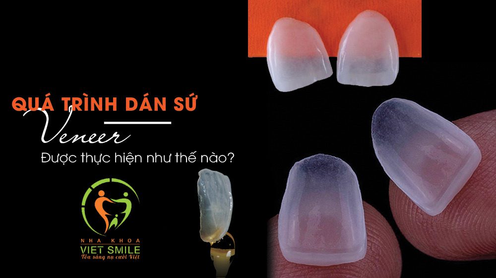 Chi phí dán sứ răng cửa bao nhiêu tiền? Bảng giá sứ veneer 7 Quy trình dán sứ veneer tiêu chuẩn